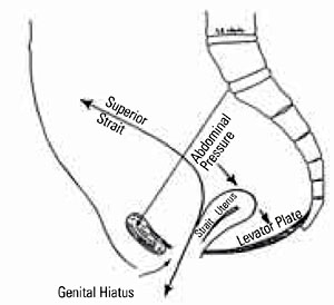 Delancey's three levels of pelvic support – Dutch lables