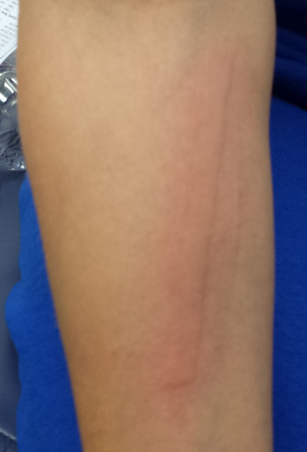 superdrug-health-clinic-red-lines-on-skin-that-look-like-scratches