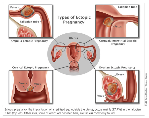 Medical Management Of Ectopic Pregnancy Early Diagnosis Is Key Clinician Reviews