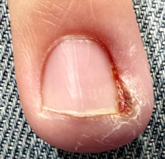 hangnail