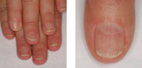 Nail involvement in systemic sclerosis | Semantic Scholar