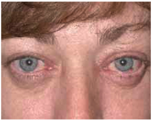 announcer vedtage status Red eyes with a brown spot | MDedge Family Medicine