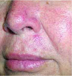 Red facial rash with “granitos” | MDedge Family Medicine