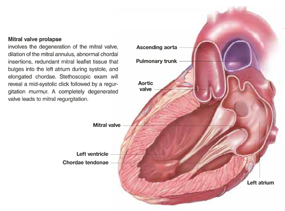 when-should-patients-with-mitral-valve-prolapse-get-endocarditis