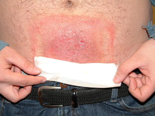 Are there any causes for rashes in the groin/abdomen area that I