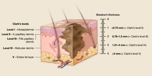 Cutaneous Melanoma Detecting It Earlier Weighing Management Options 