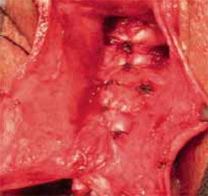 Anterior vaginal prolapse (cystocele) - Diagnosis and treatment