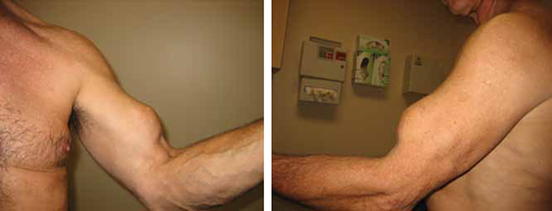 When Is A Conservative Approach Best For Proximal Biceps Tendon Rupture