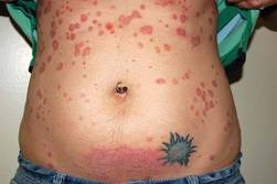 developed psoriasis during pregnancy