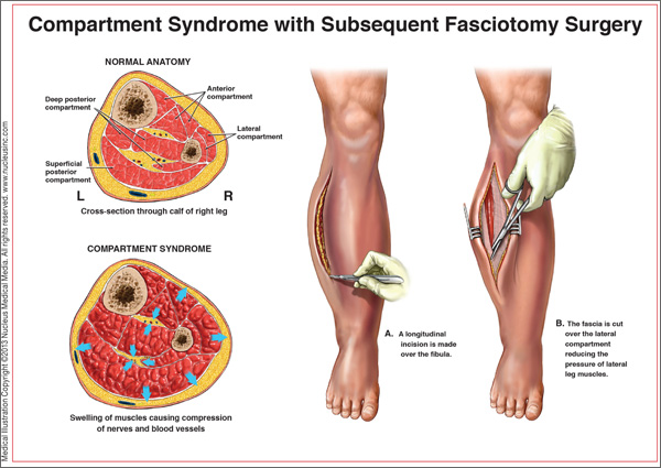 Acute Compartment Syndrome: To Save a Limb