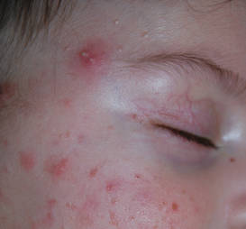 does hpv virus cause acne