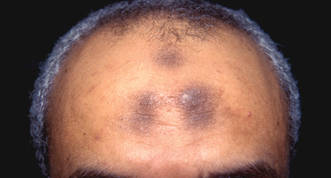 Cutaneous Signs of Piety | MDedge Dermatology