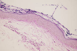 Multiple short hyphae and spores in the horny layer visible with periodic acid–Schiff staining, with typical “spaghetti and meatballs” appearance (original magnification ×20).