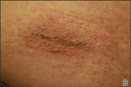 Allergic Contact Dermatitis to 2-Octyl Cyanoacrylate | MDedge Dermatology