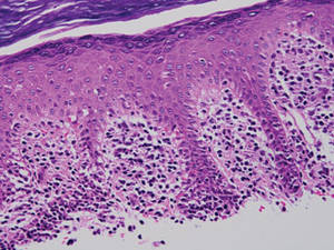 Histopathology revealed a bandlike inflammatory infiltrate with associated vacuolar interface change and a few eosinophilic bodies (H&E, original magnification ×10)