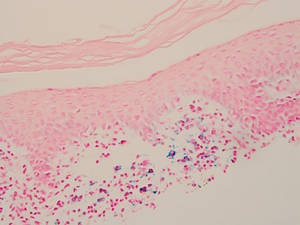 Iron stain revealed siderotic macrophages and hemosiderin deposition (original magnification ×10)