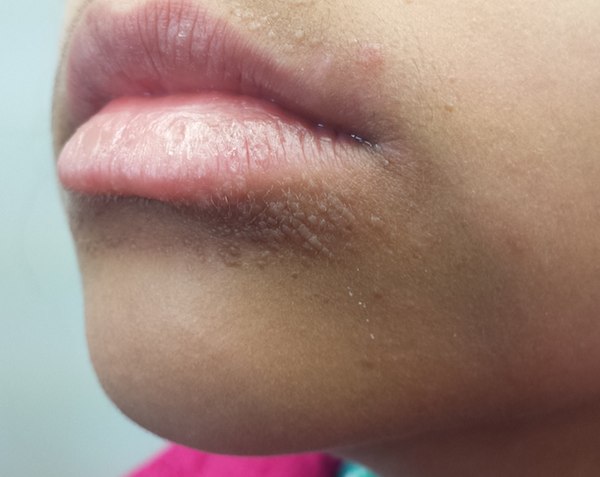 young-patient-with-bumps-near-her-mouth-clinician-reviews