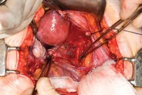 Laparoscopic oophorectomy - Mayo Clinic