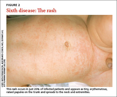 Roseola (Sixth Disease) Symptoms & Causes