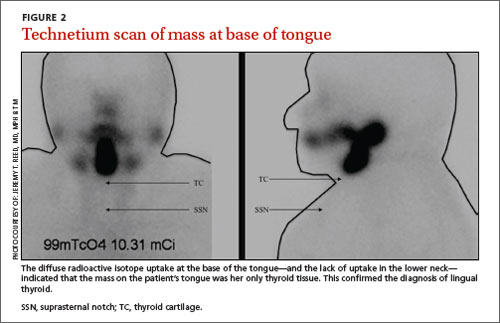 large-mass-on-base-of-tongue-mdedge-family-medicine