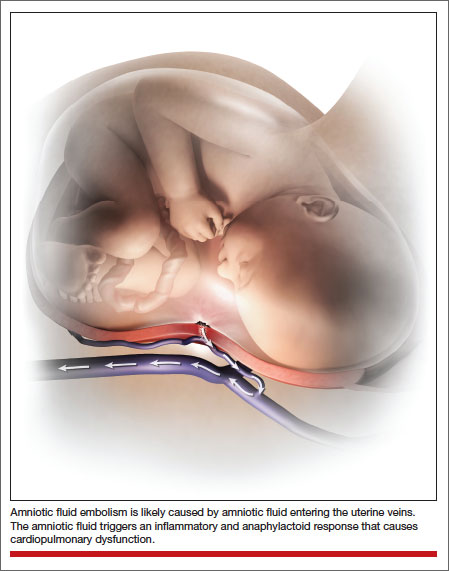 Amniotic Fluid Embolism (AFE): Causes, Symptoms & Treatment