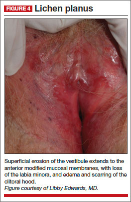 Chronic vulvar symptoms and dermatologic disruptions: How correct diagnosis | MDedge