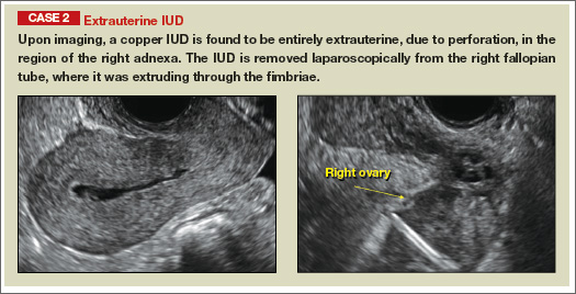 paragard iud ultrasound