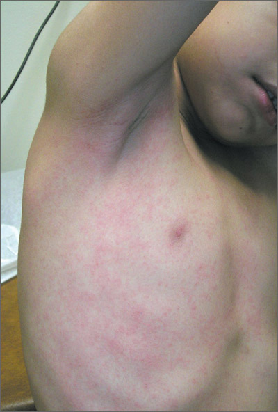 strep rash on chest
