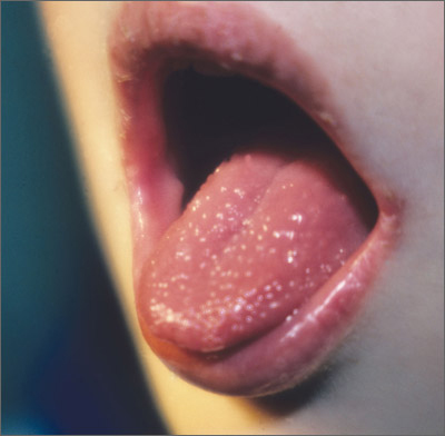 treatment for tongue papillae