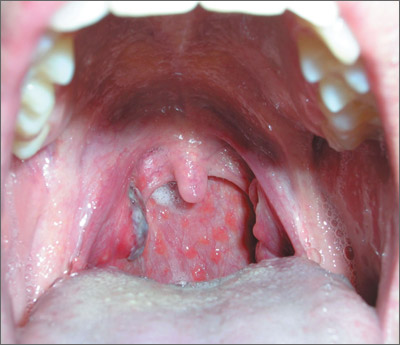 Dark area on tonsil | MDedge Family