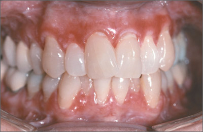 psoriasis bleeding gums