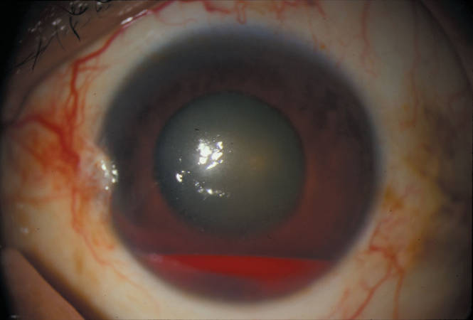Eye pain and redness MDedge Medicine
