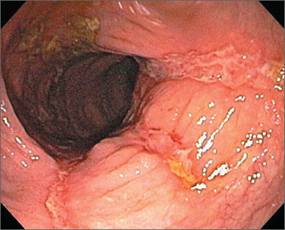 ulcerative colitis mucus in stool