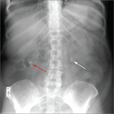 Flank Pain/Renal Colic