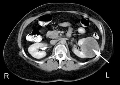 Bilateral Flank Pain