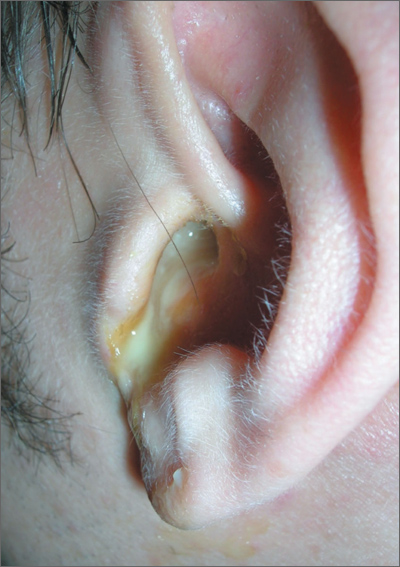 Fluid In Ear Draining