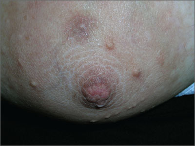 sebaceous glands bumps