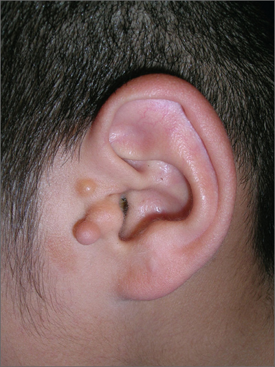 goldenhar syndrome ear