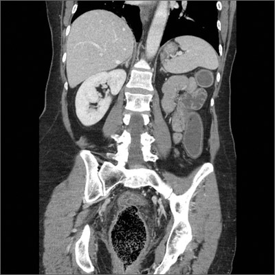 Obstipation | MDedge Family Medicine