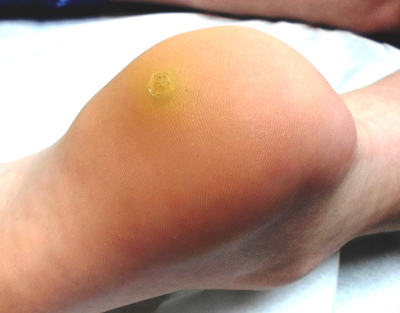 Hpv virus warts on legs - Hpv virus plantar warts Papilloma virus che cose Wart on leg skin cancer