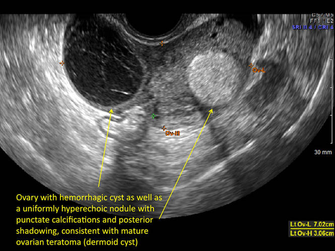 Hemorrhagic Ovarian Cysts One Entity With Many Appearances MDedge Hemorrhagic Ovarian Cysts One Entity With Many Appearances MDedge