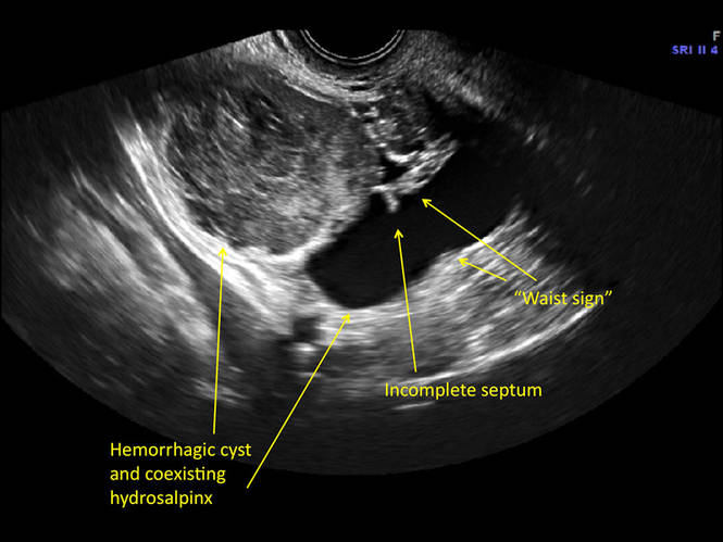 Hemorrhagic Cyst Ultrasound