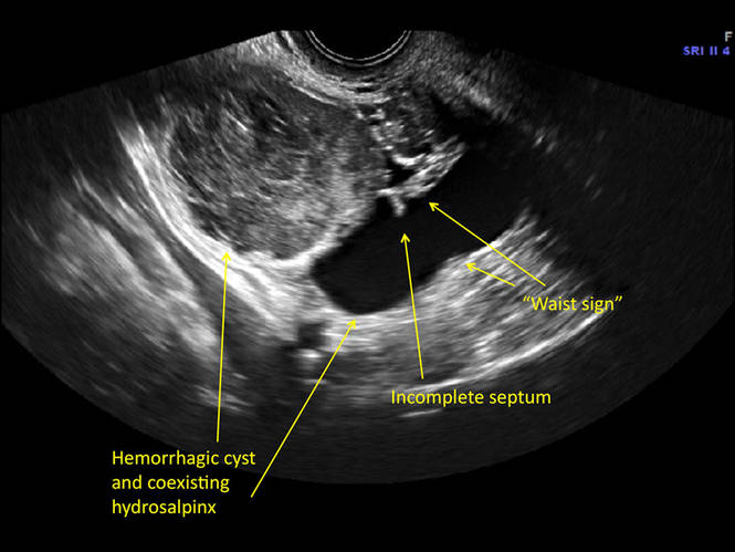 Hemorrhagic Ovarian Cyst Leaking Symptoms TLWK Hemorrhagic Ovarian Cyst Leaking Symptoms TLWK