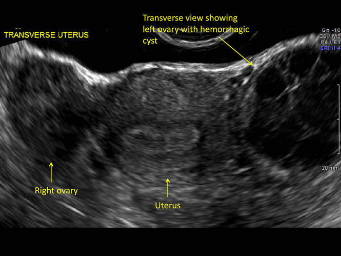 Hemorrhagic Ovarian Cyst Ultrasound