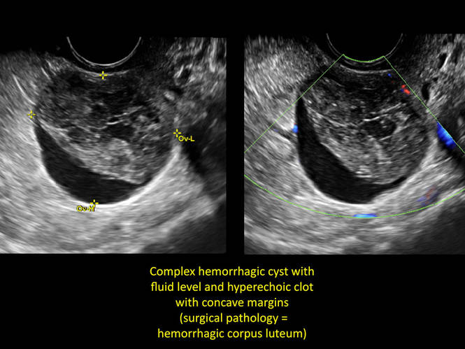 Hemorrhagic Cyst Ultrasound