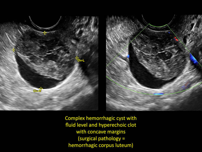 What Causes A Bleeding Ovarian Cyst With Pictures What Causes A Bleeding Ovarian Cyst With Pictures