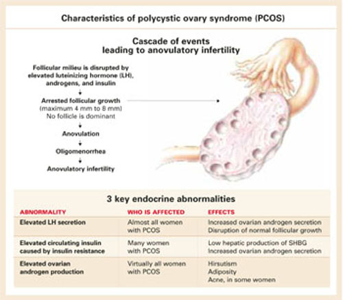 Metformin and polycystic ovary syndrome