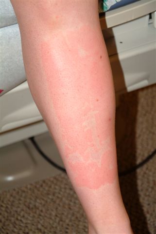 allergic reaction rash on legs