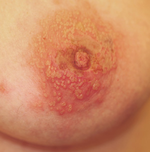 Rash on side of boob inhale been rubbing my boob bc I have sore breasts  from fibrocystic breast's I had an ingrown removed form my nipple that was  inflamed and then the