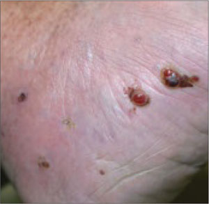 Red Papules and Nodules
